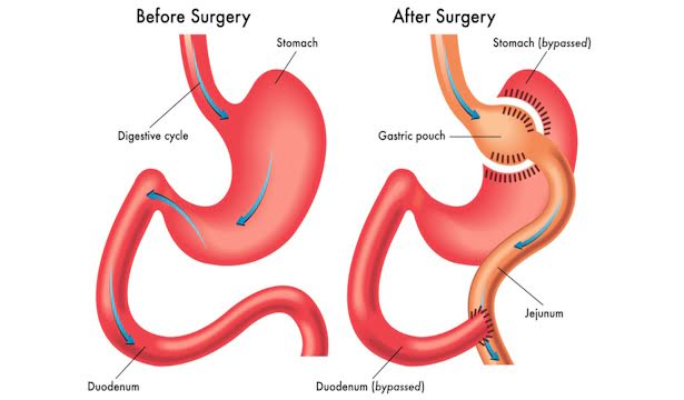Gastric bypass in Nairobi - Weight loss in Nairobi