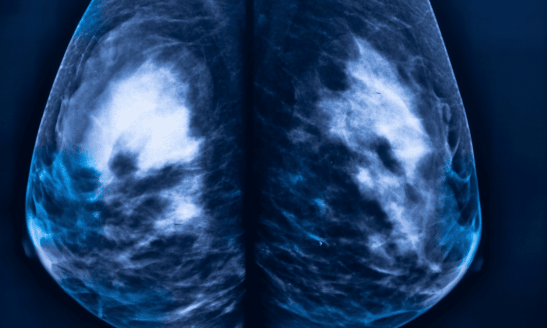 Mammogram services in Nairobi