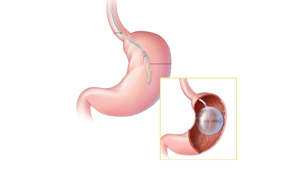 Intragastric Baloon weightloss in Nairobi - main