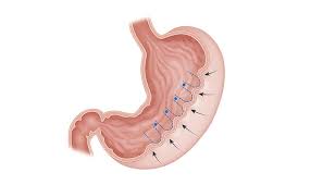 Endoscopic Gastric Sleeve in Nairobi
