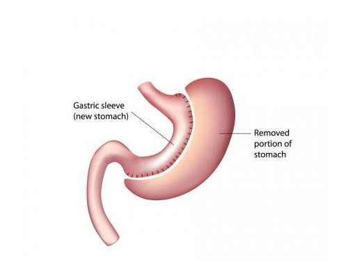 Laparoscopic Gastric Sleeve in Nairobi